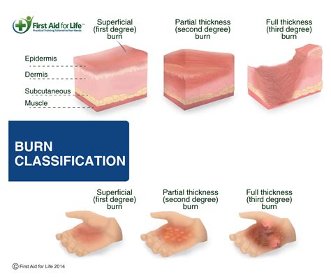Burn Classifications