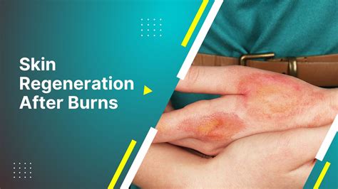 burn healing diet