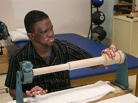 Burn rehabilitation