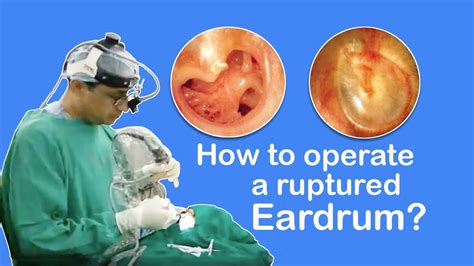 Burst Eardrum Causes