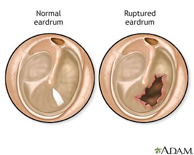 Burst Eardrum Complications