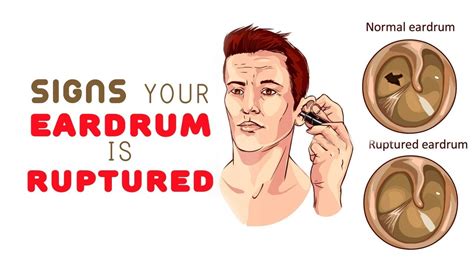 Burst Eardrum Symptoms