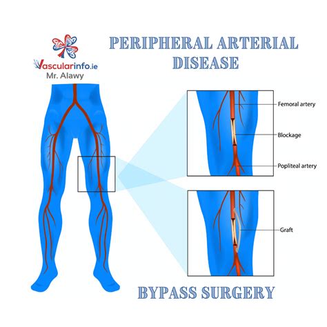 bypass surgery
