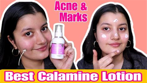 calamine lotion for acne and pimples