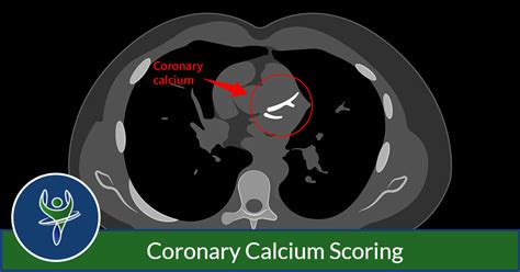 Calcium Scan Tips