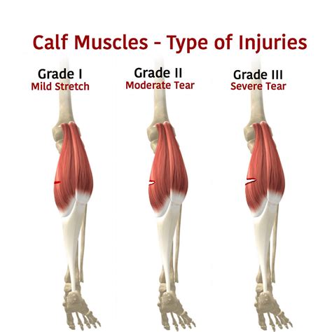 Calf Strains