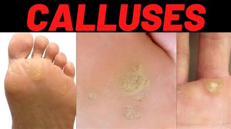 Causes of Calluses