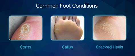 callus prevention