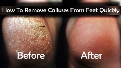 callus removal methods