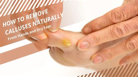 callus removal tips