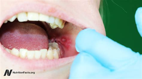 canker sore nutrition
