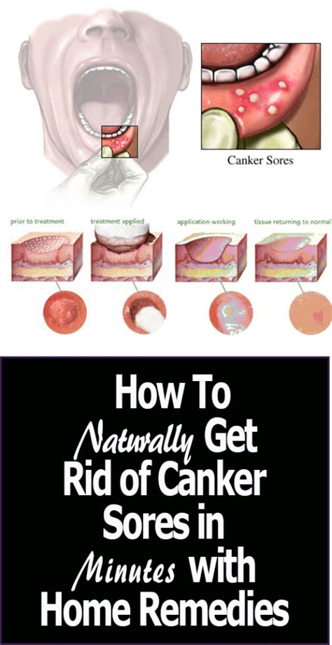 canker sore treatment