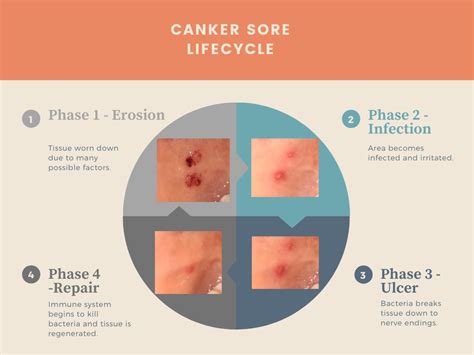 canker sores formation