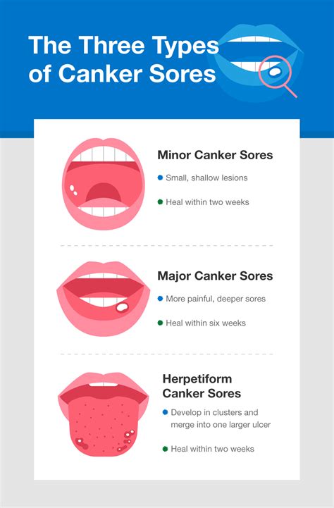 canker sores on tongue causes