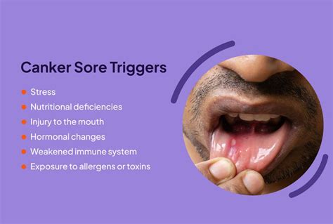 canker sores triggers