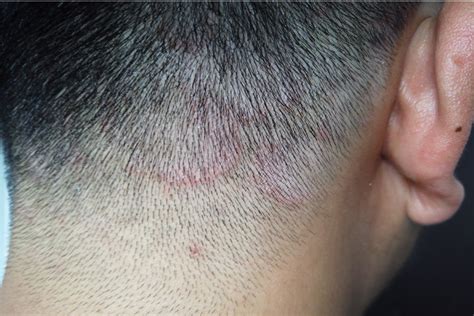caring hair ringworm
