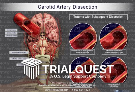carotid dissection illustration