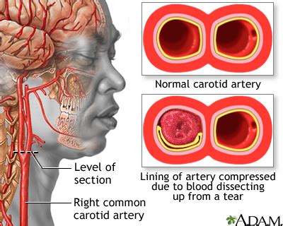 carotid dissection conclusion illustration