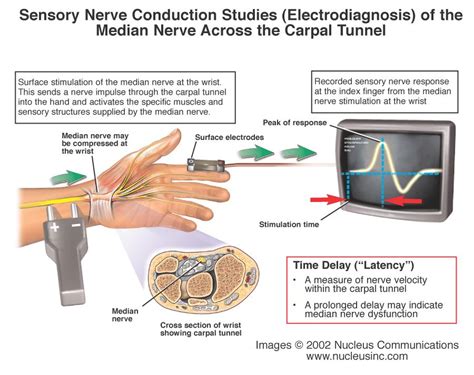 Carpal Tunnel Research