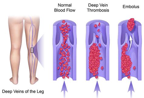 Cause of Leg Vein Thrombosis