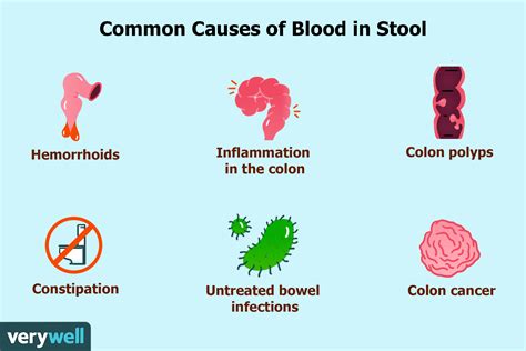 Causes of Blood in Feces