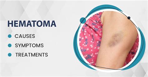 Causes of Hematomas