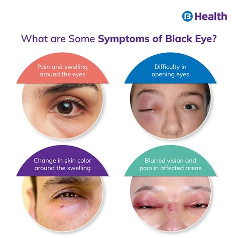 Causes of Black Eye