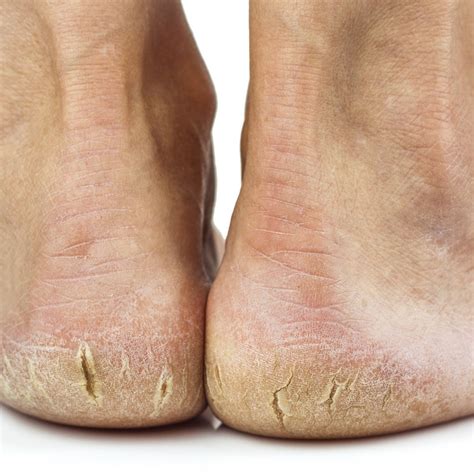 causes of cracked feet