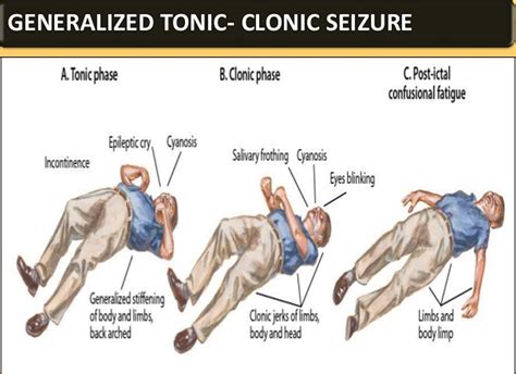 Causes of Grand Mal Seizures