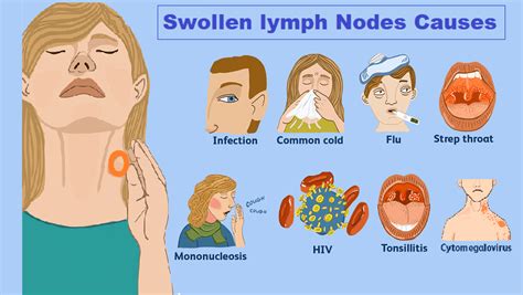 Causes of Jaw Lymph Node Swelling