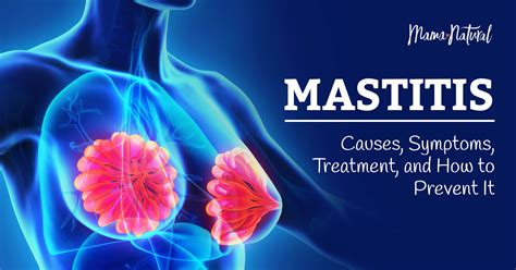 Causes of Mastitis Image