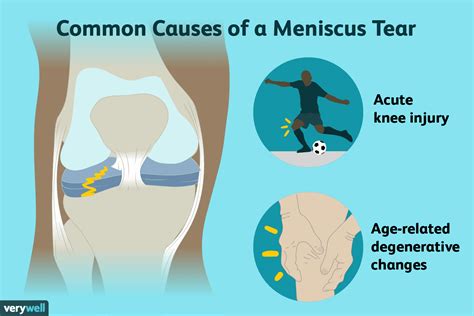 causes of meniscus tear