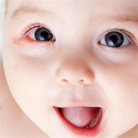 causes of pink eye in infants