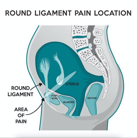 causes of round ligament pain