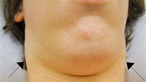 Causes of Swollen Under Jaw Lymph Nodes