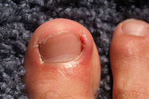 causes of toe nail bed pain