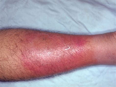 Cellulitis Leg Pictures