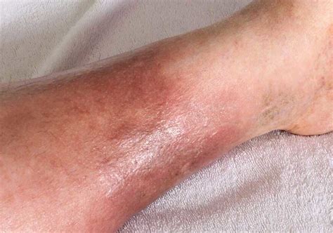 cellulitis on feet