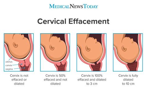 Cervical Effacement
