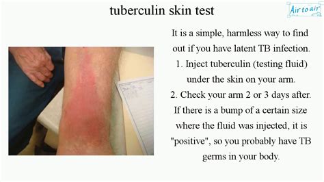 Challenges and limitations of PPD skin test