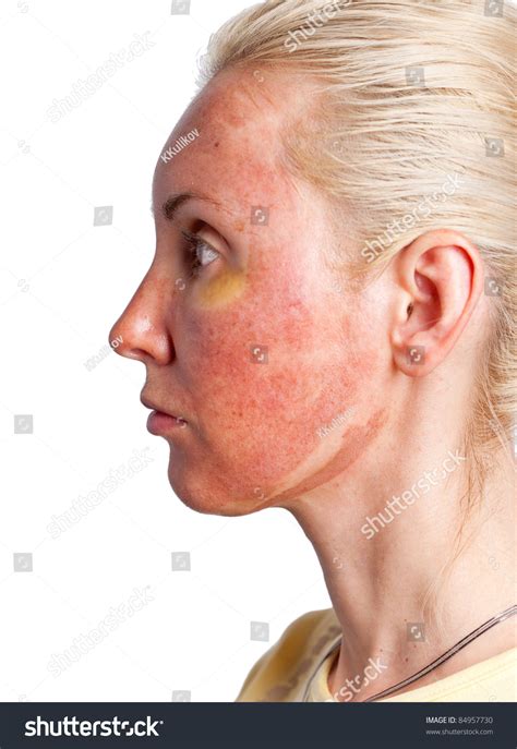 chemical burn facial treatment