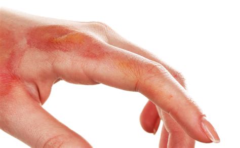 chemical burns