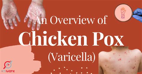 Incubation Period of Chickenpox