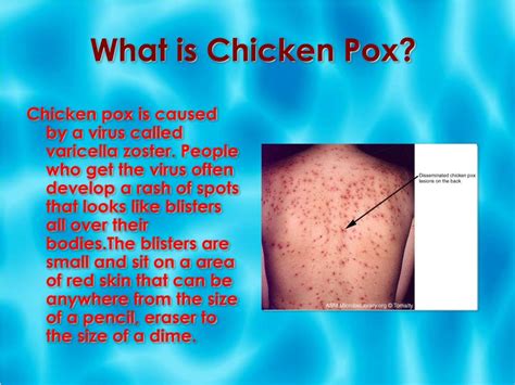 Introduction to Chickenpox