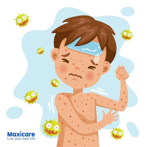 Public Health Perspective on Chickenpox