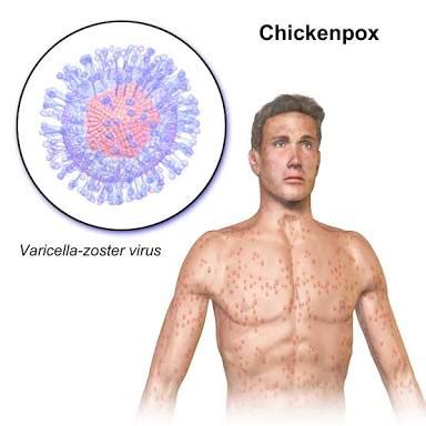 Future Directions in Chickenpox Research