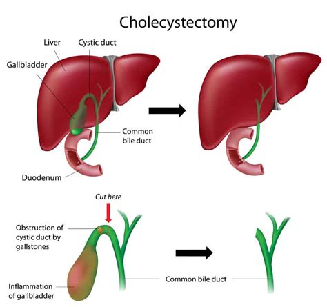 cholecystectomy procedure