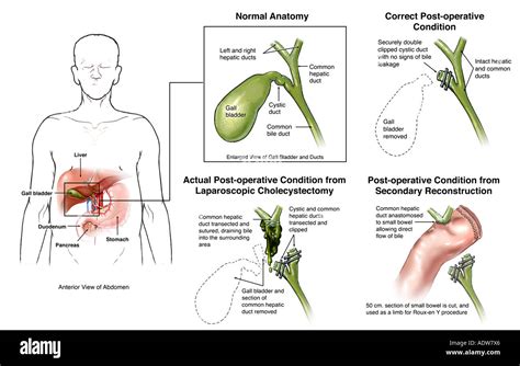Cholecystectomy Surgery