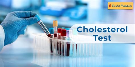cholesterol profile test results