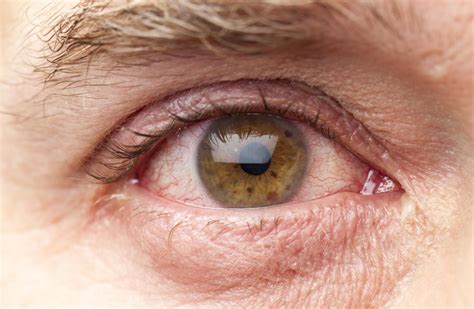 clogged eye duct causes
